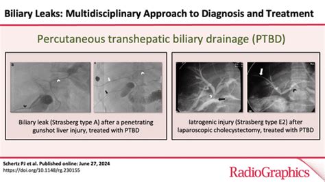 Biliary Leaks: Multidisciplinary Approach to Diagnosis。